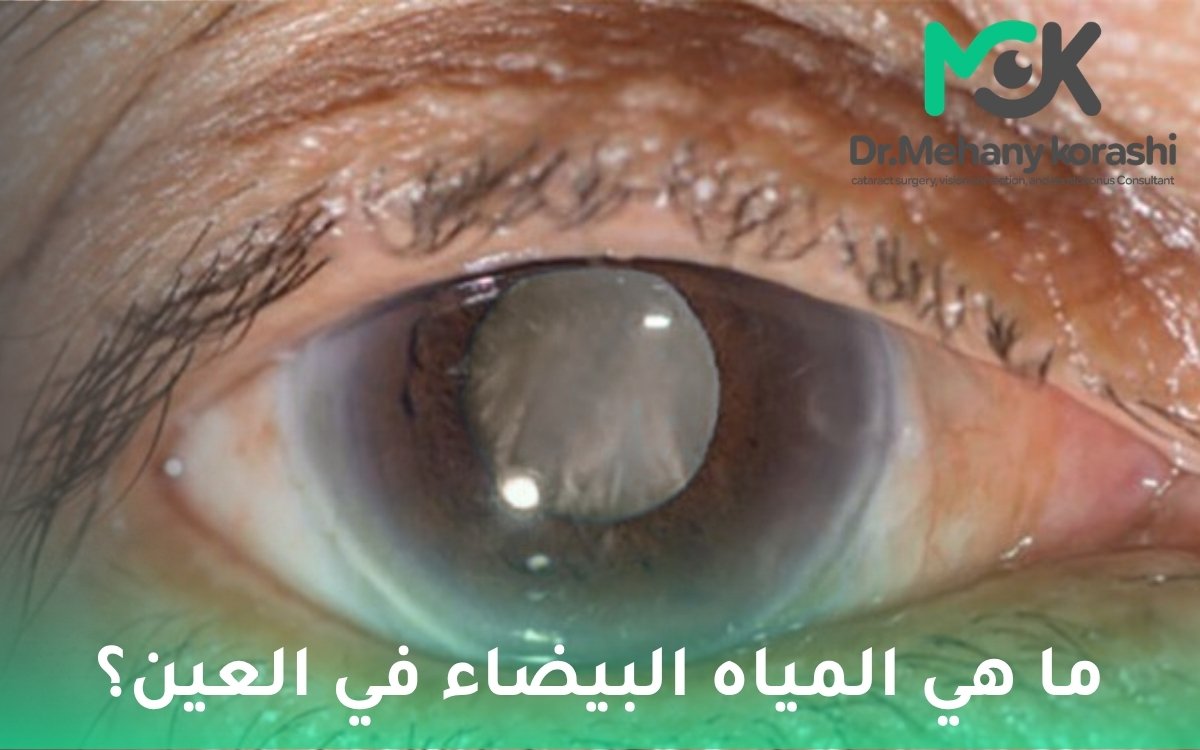 ما هي المياه البيضاء في العين