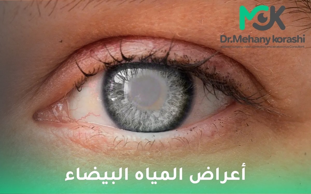 أعراض المياه البيضاء