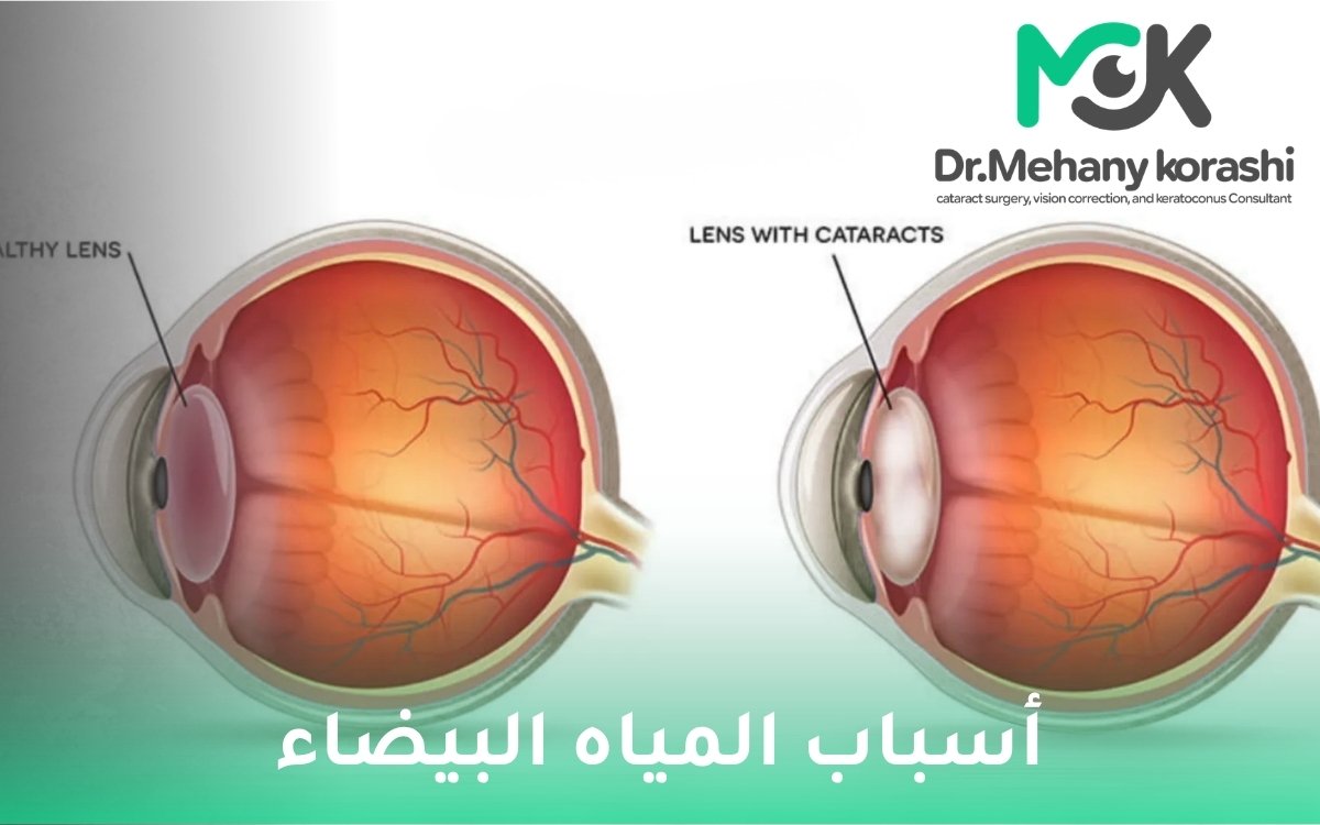 أسباب المياه البيضاء