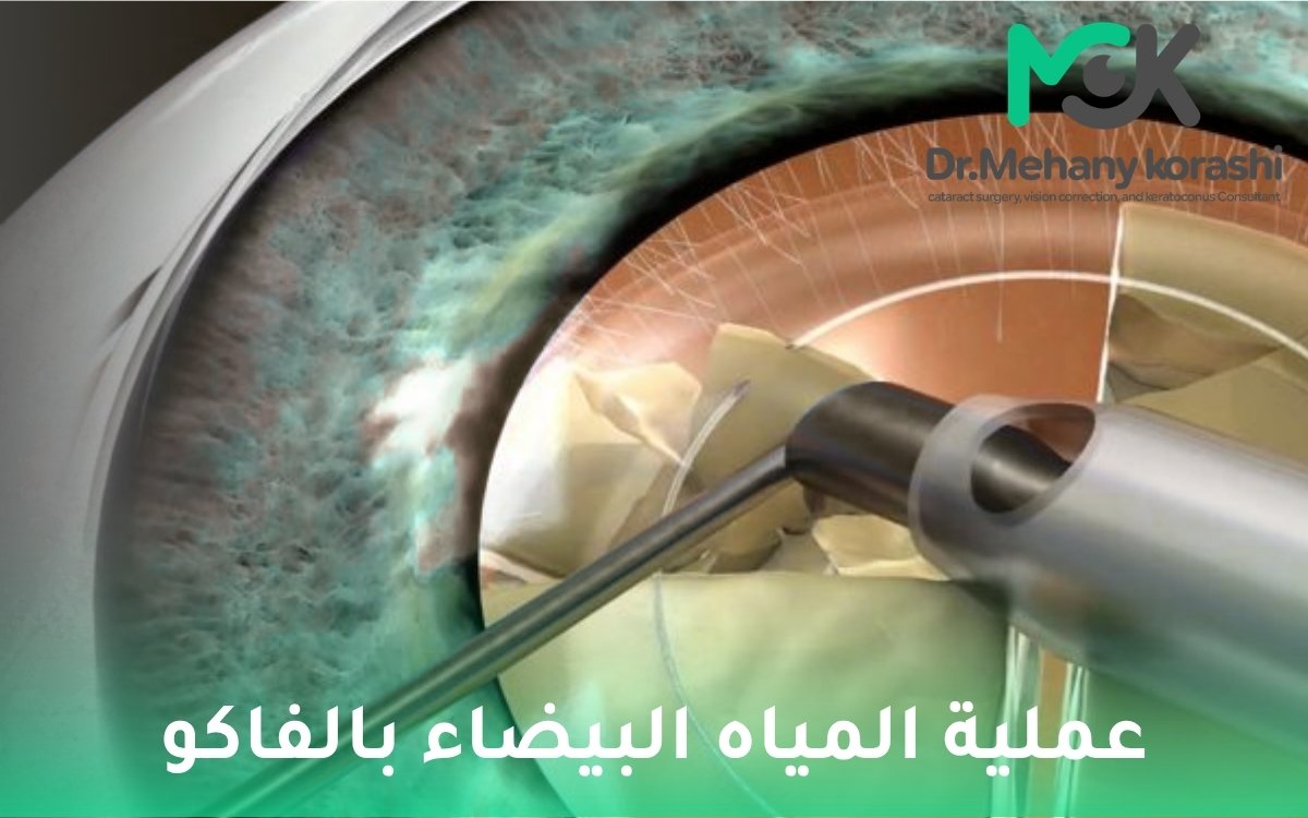 عملية المياه البيضاء بالفاكو