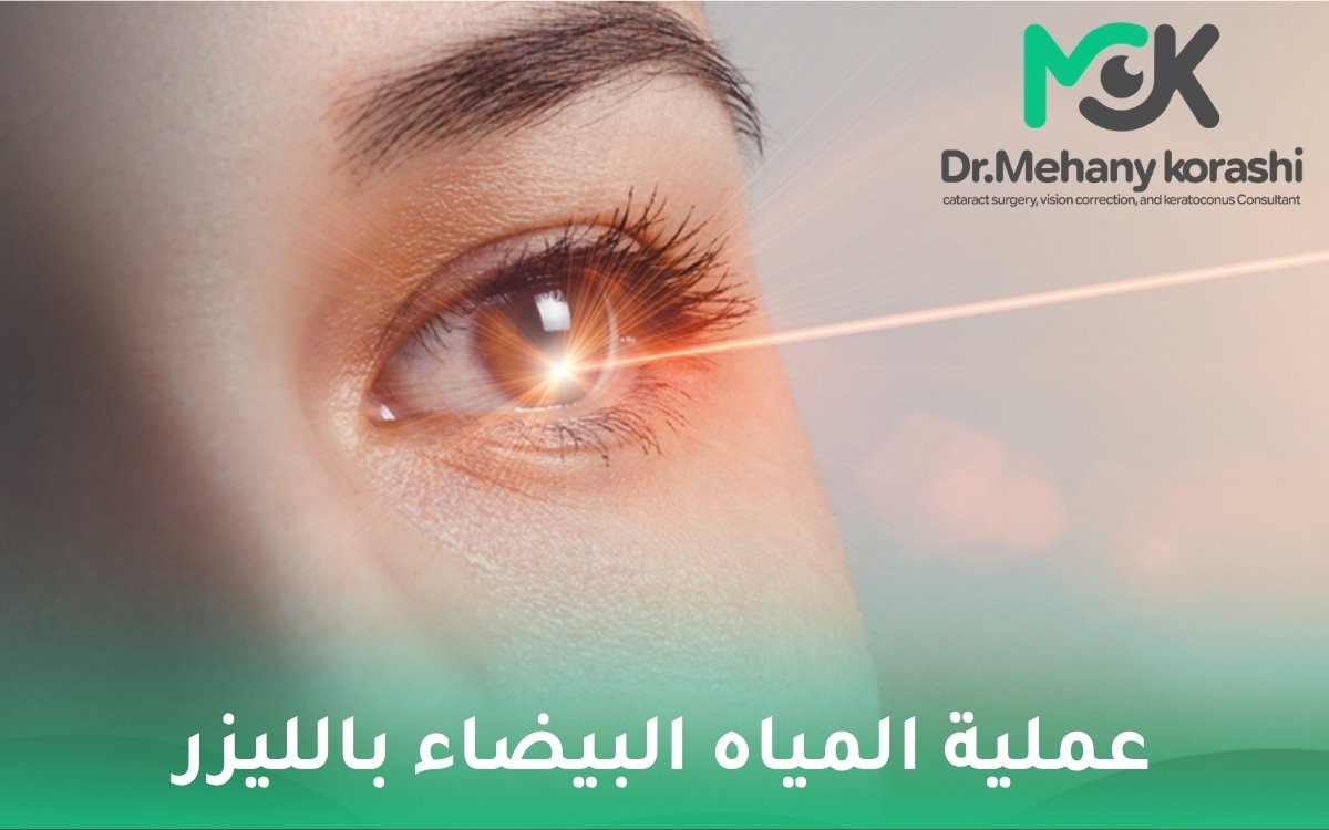 عملية المياه البيضاء بالليزر