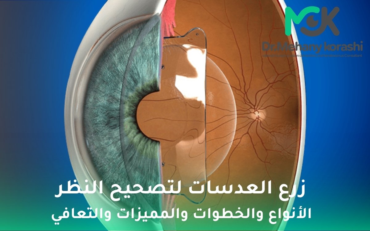 زرع العدسات لتصحيح النظر