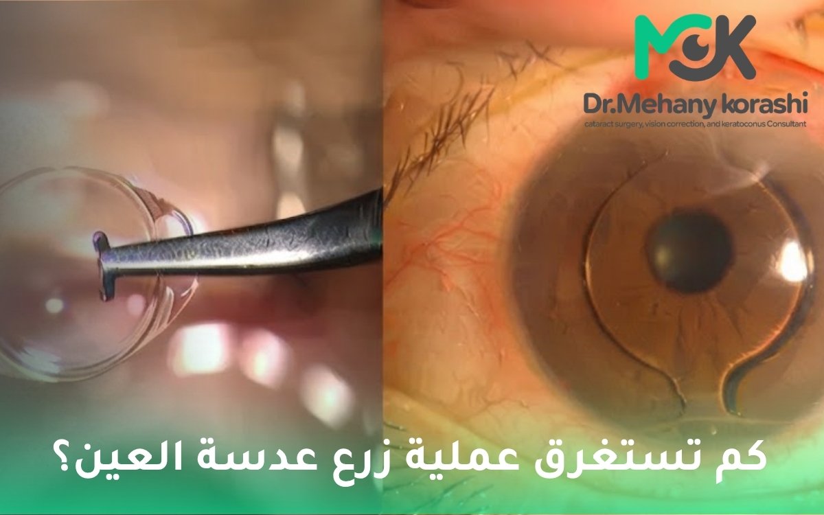 كم تستغرق عملية زرع عدسة العين