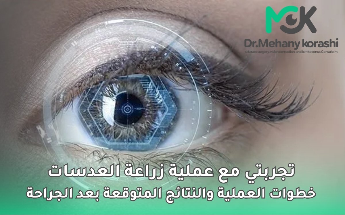 تجربتي مع عملية زراعة العدسات