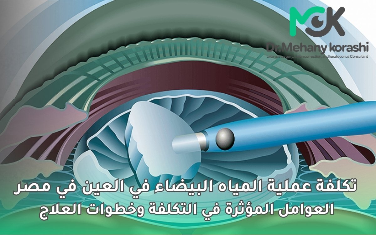 تكلفة عملية المياه البيضاء في العين في مصر