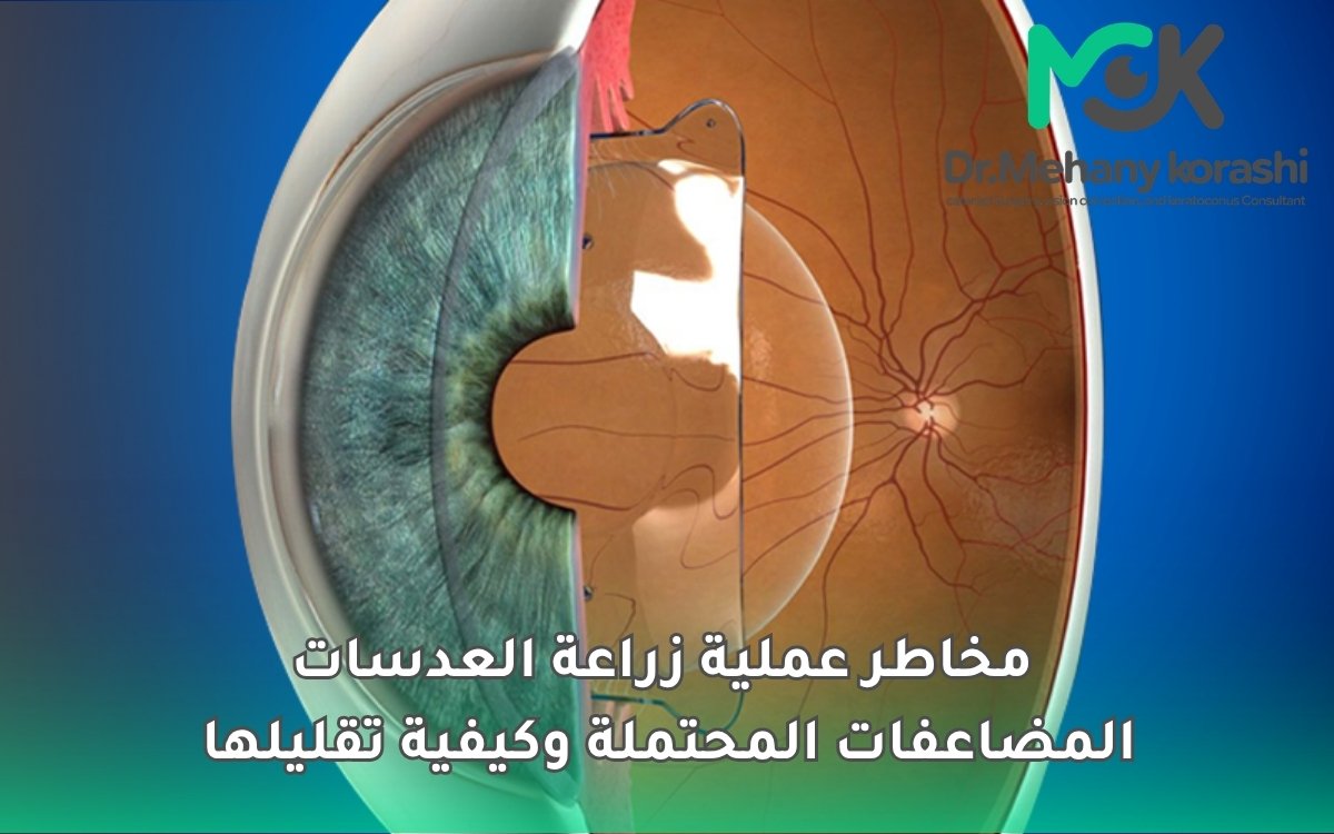 مخاطر عملية زراعة العدسات